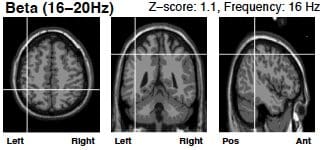 beta wave brain scan after neurofeedback